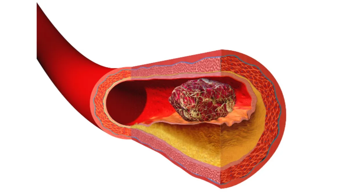 Illustration of a cut-away blood vessel with a blood clot made of red cells and fibrin strands inside