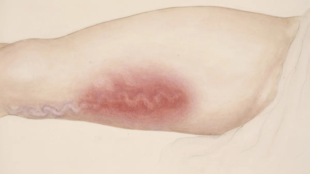 Watercolour painting of a leg showing a winding vein with a reddened, inflamed patch of skin around part of it