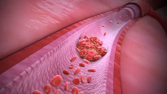 3D illustration of a blood clot forming inside a blood vessel with red blood cells flowing past
