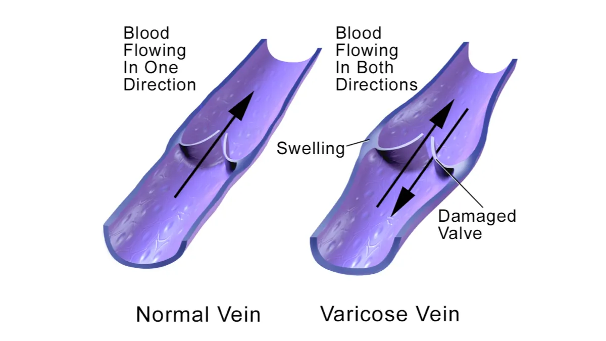 Diagram comparing a normal vein, with blood flowing one way, and a vein with a damaged valve, with blood flowing both ways