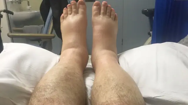 Both lower legs and feet lying on a bed, with visibly puffy ankles and feet and pillows on either side