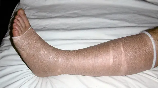 Leg wrapped in a two-layer padded compression bandage from toes to below the knee, resting on a white sheet